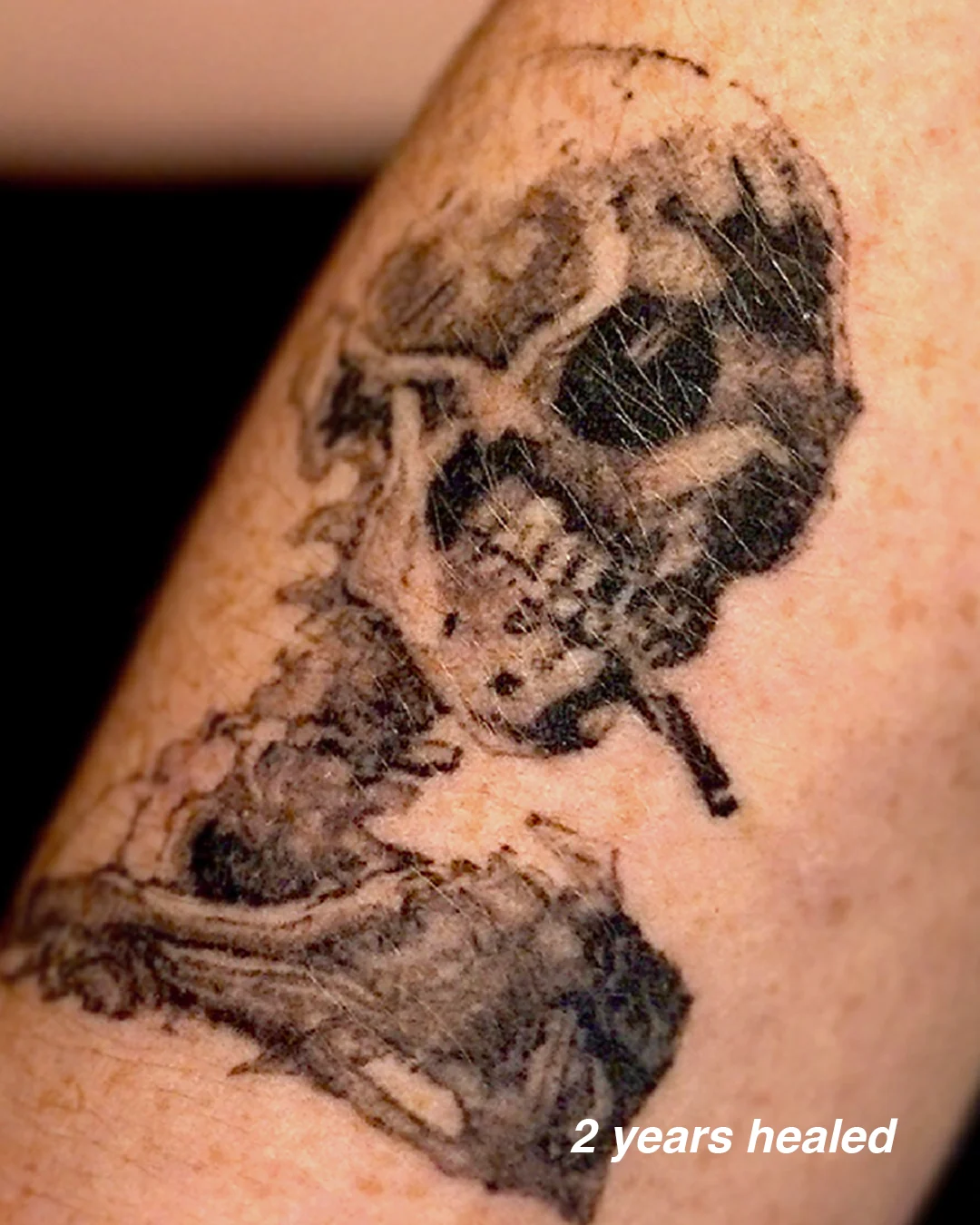 Woodcut-style tattoo of a skeletal figure of death, healed two years