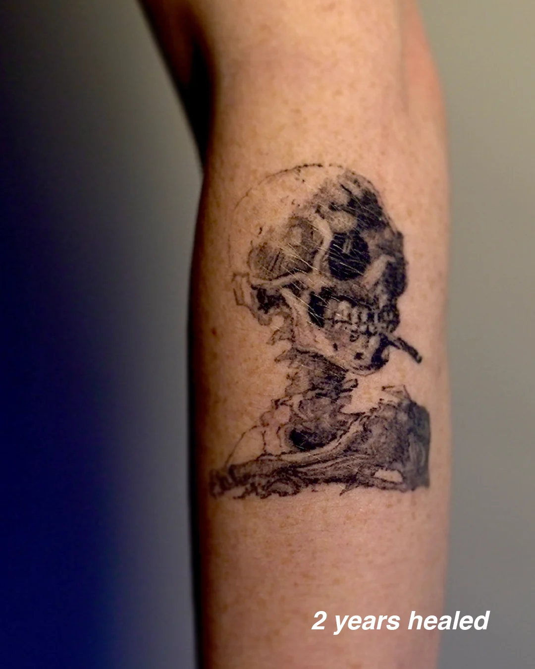 Engraving-style tattoo of Van Gogh's skull with a burning cigarette, healed two years